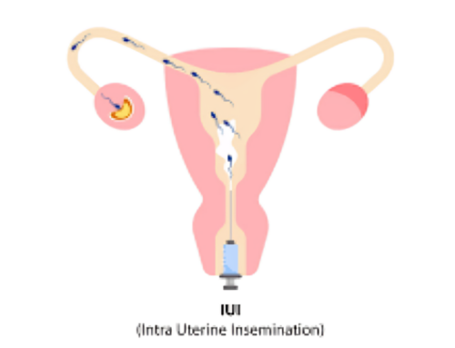 IUI Treatment in Warangal — A Complete Guide to Intrauterine Insemination