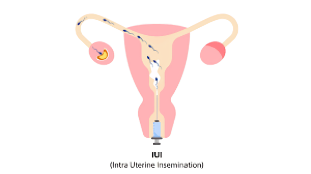 IUI Treatment